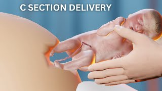 Cesarean Delivery 3D Animation | C Section Delivery #babydelivery