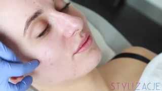 PEELING CHEMICZNY NA BAZIE KWASU PIROGRONOWEGO W DERMEA