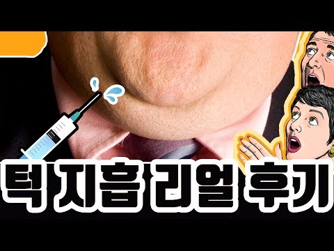 이중턱 지방흡입 리얼후기! 이중턱이 없어졌다!  [쀼]