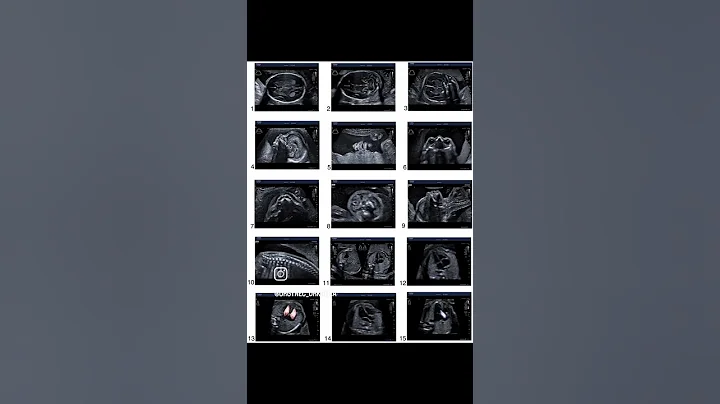 An anomaly/TIFFA scan, is done btw 18-22 weeks, to check for structural abnormalities#shorts#baby