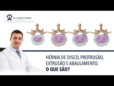 Vídeo: Como é Tratada A Protrusão Do Disco Lombar?