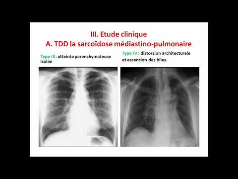 Vidéo: Cancer Du Poumon Gauche Chez Un Patient Présentant Une Absence Unilatérale Congénitale De L'artère Pulmonaire Gauche: Rapport De Cas Et Revue De La Littérature