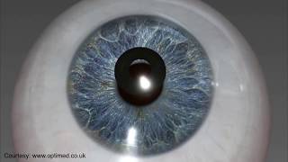 Health and Wellness: Dr. Danny Lee's KAMRA Inlay Procedure