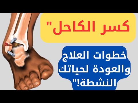 طريقة علاج كسر مفصل الكاحل كسر مفصل الكاحل هل لازم عملية اعراض كسر الكاحل طرق علاج كسر الكاحل