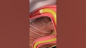 Mechanical Thrombectomy in stroke #medicine #anatomy #science #health #stroke