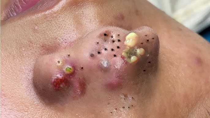 Big Cystic Acne Blackheads Extraction Blackheads & Milia, Whiteheads  Removal Pimple Popping # 1694 - YouTube