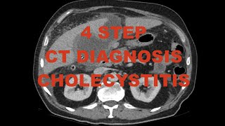 4 step diagnosis - Acute Cholecystitis on CT scan -  case review with differential diagnoses