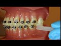 HOW TO USE WAX ON BRACES