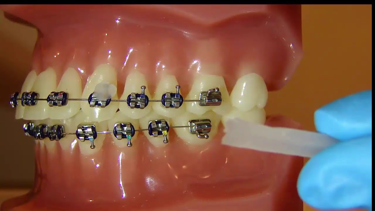 How to Apply Dental Wax to Braces?  