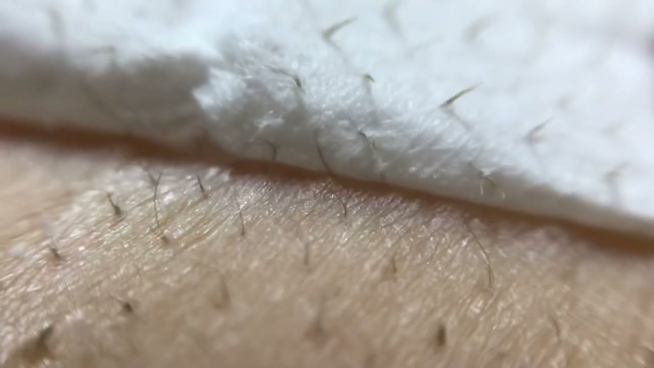背中 毛穴 詰まり 黒い