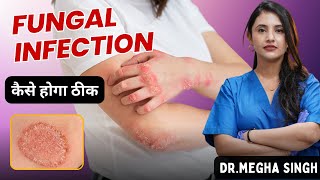 Fungal Infection कय हत ह? Causes, Symptoms And Treatment Fungal Infection Dr. Megha Singh