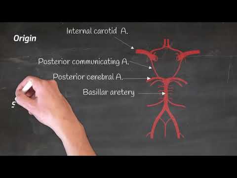 Posterior cerebral artery stroke.. weber, Cloud and Benedict syndrome.