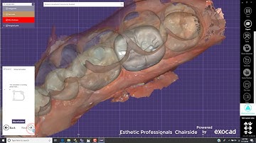 CS3600 TO CS3100 with EXOCAD CHAIRSIDE by Esthetic Professionals.....