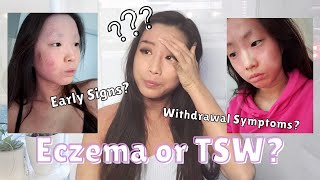 Early Signs + Symptoms of Topical Steroid Withdrawal