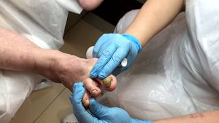 Обработка грибковых ногтей. Медицинский педикюр. Обработка грибковых ногтей. Медицинский педикюр.