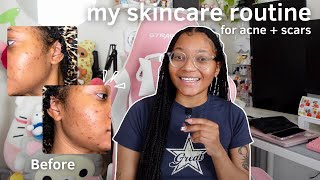 my skincare routine for acne & scars: sharing my journey, morning/nighttime routine, etc. (2024)