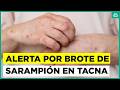 Alerta sanitaria por brote de sarampión en Tacna