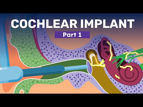 Video: Adakah implan koklea memulihkan pendengaran normal?
