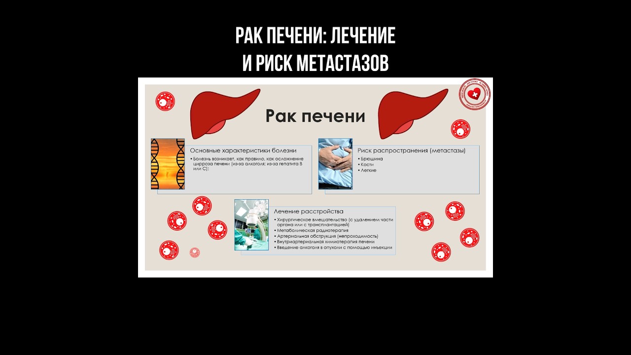 Рак печени: лечение и риск метастазов #рак #печень #ракпечени # ...