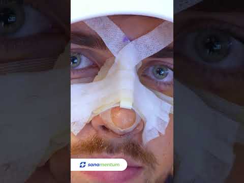 Piezo Rhinoplasty in