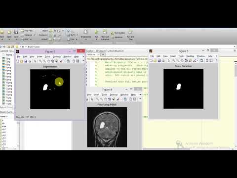 Brain Tumor Detection Using Image Processing Matlab Project
