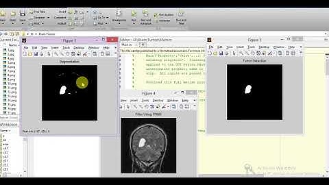 Brain Tumor Detection Using Image Processing Matlab Project