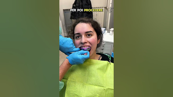 FINALMENTE METTO L’APPARECCHIO PER I DENTI 😍🦷