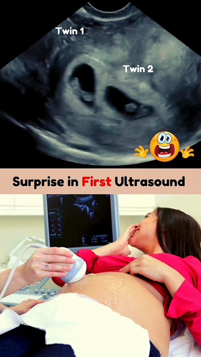 Biggest but Best Surprise ЁЯе░ Twins on First Pregnancy Ultrasound Scan #pregnancy #twin