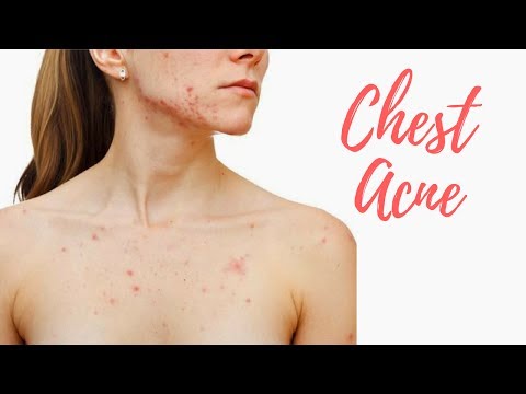 GET RID OF CHEST ACNE