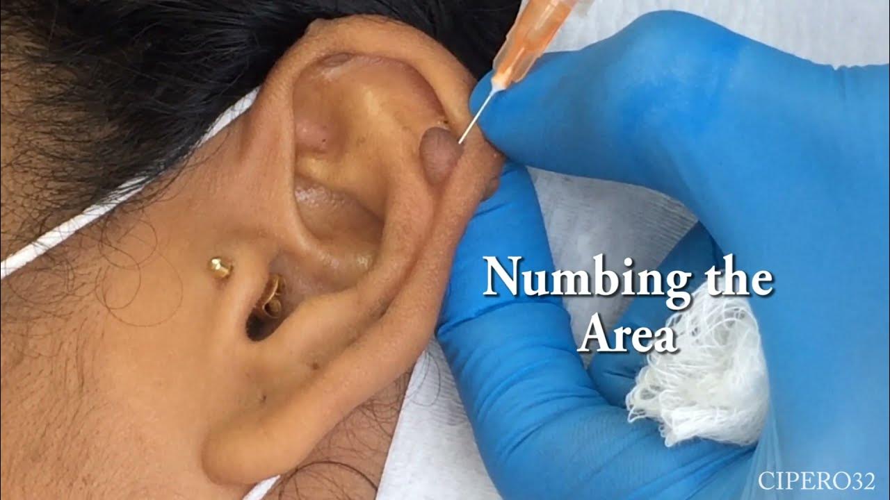 Big Red Bump On Earlobe