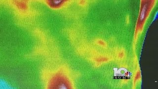 Breast Thermography