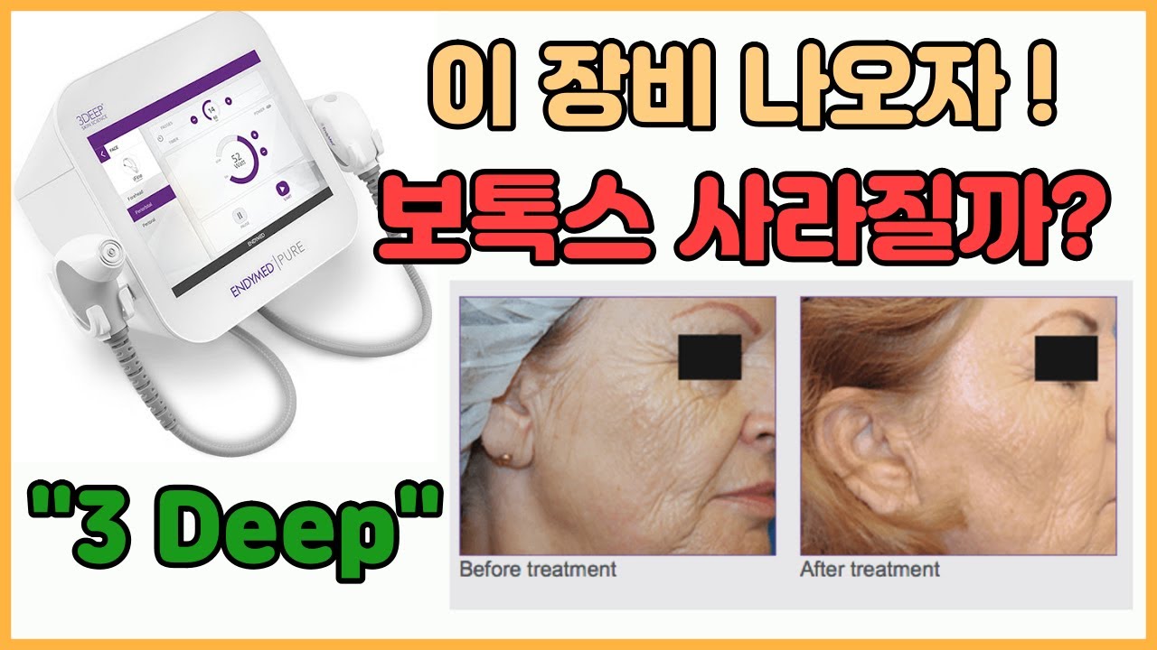 [델타피부과] 주름펴는 이스라엘 고주파 장비, 3 deep(3 딥, 3deep)을 소개합니다. 탄력, 리프팅, 흉터 등에도 ...