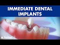Immediate dental implants post-extraction for tooth replacement ©