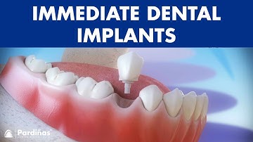 Immediate dental implants post-extraction for tooth replacement ©