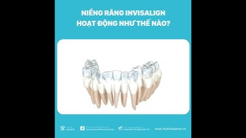 Niềng răng trong suốt Invisalign dịch chuyển răng bạn như thế nào?