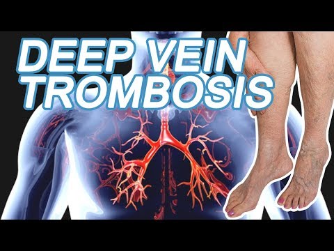 Video: Trombosis Ileofemoral - Gejala Dan Pengobatan
