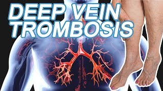 Deep Vein Thrombosis (DVT). 