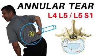 Annular Tear L4L5 L5S1 Disc Bulges