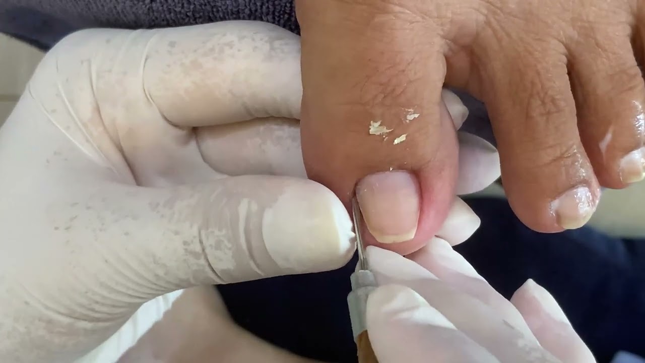 Clean The Skin And Remove Of The Nail - Toenail cleaning - Free Time With Nail 535