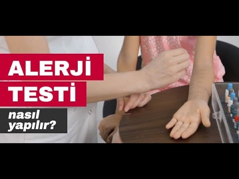 alerji testi nasil yapilir istanbul alerji youtube