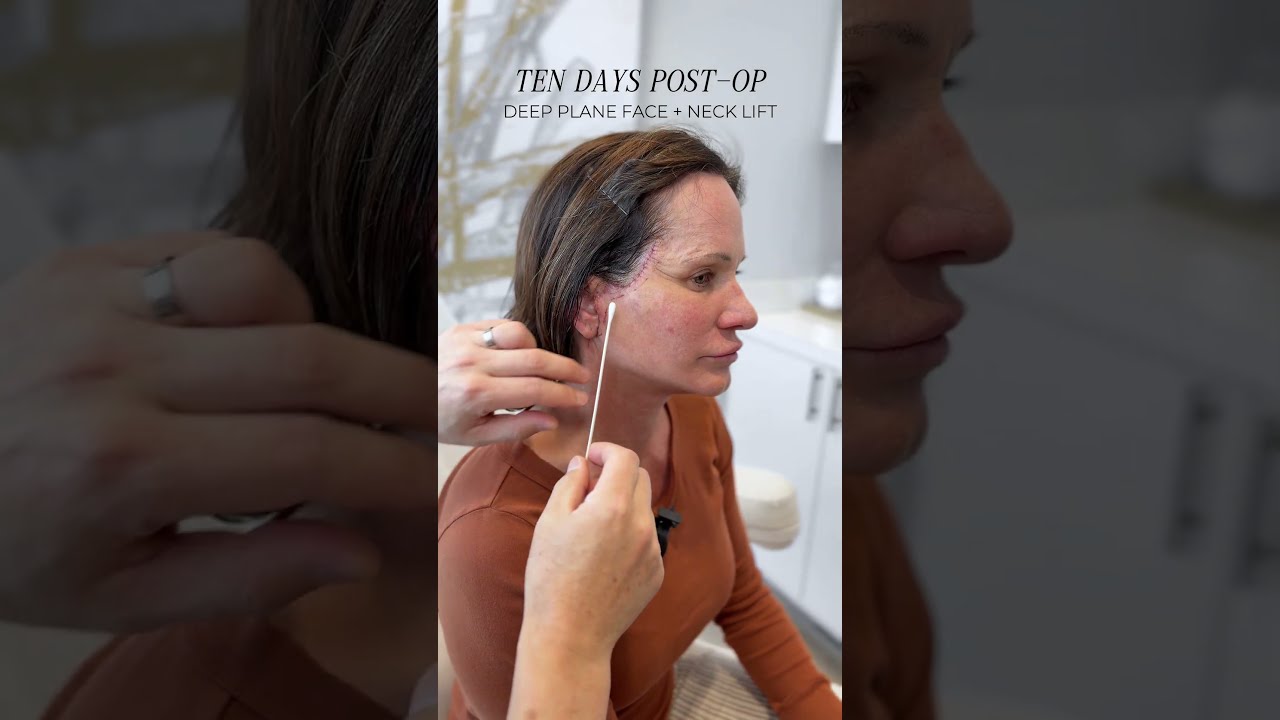 10 Days Post Op Stunning Early Results From The AdmireMD Deep Plane Face Neck Lift Facelift