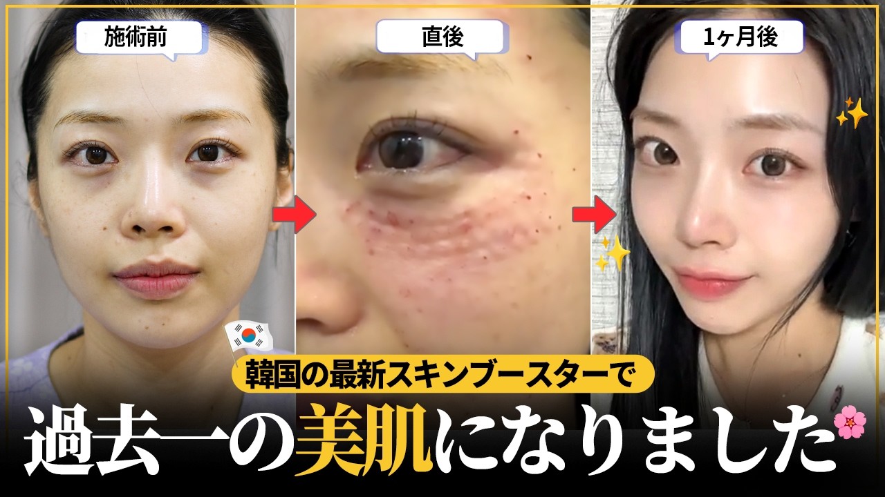 【酷いクマ・たるみ】もっと早くやればよかった｜サーマクール×リジュラン 正直レビュ