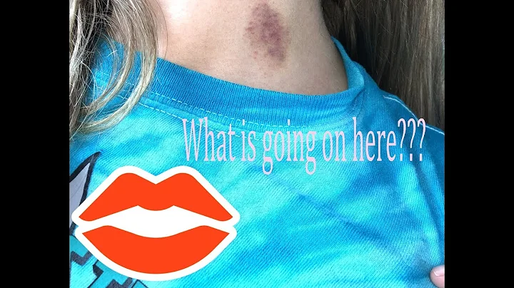 SHE GOT A HICKEY?!?!?!?!? WHAT?????