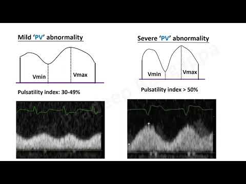 VExUS Score_USG_Dr Pradeep Rangappa