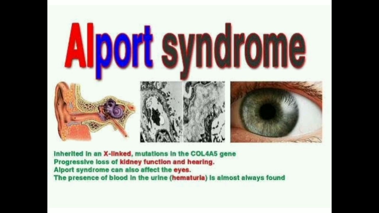 Alport Syndrome Eye