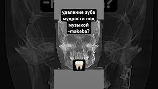 Makeba? удаление зуба мудрости за 25 секунд🥵 #шортс #медицина #зубы