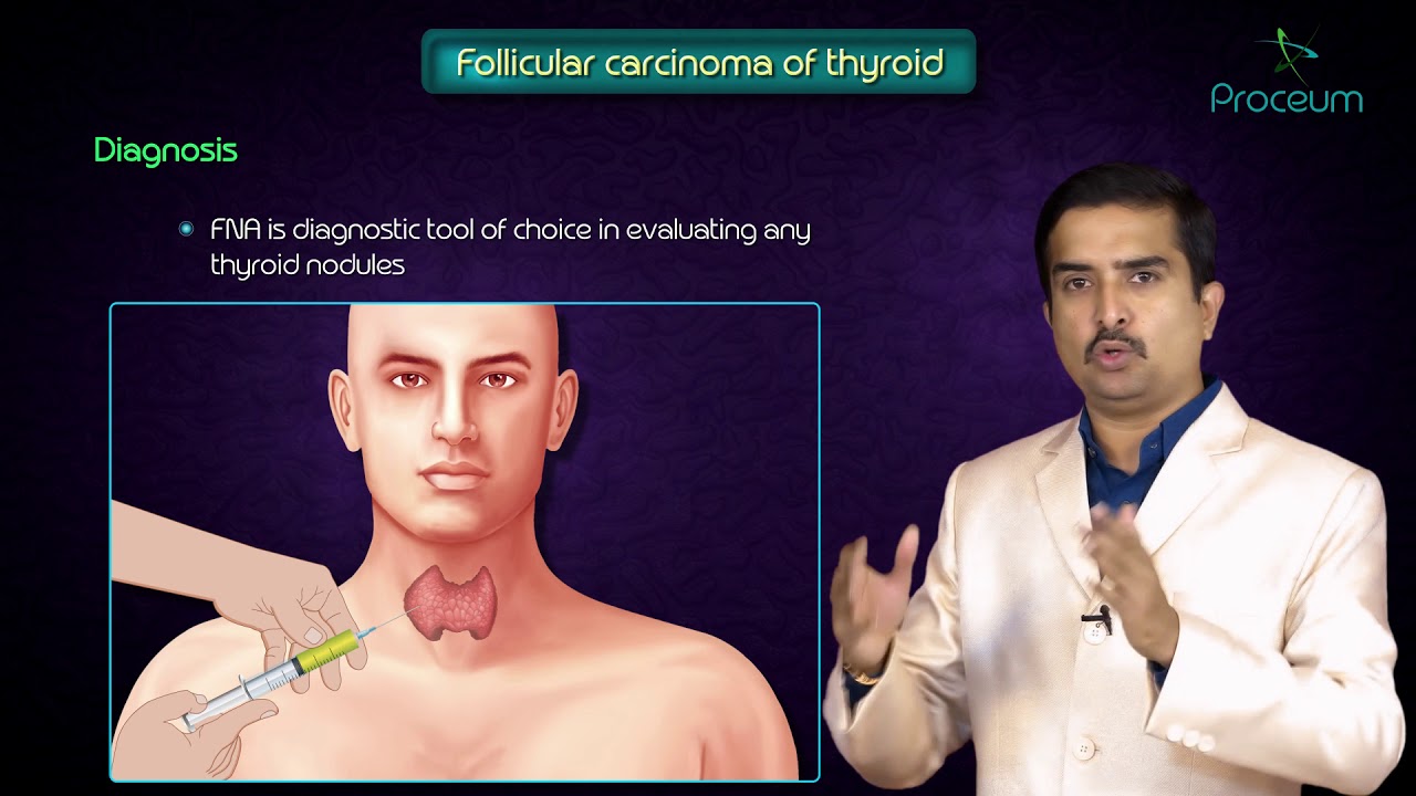 Thyroid Neoplasms Part 2 ( Follicular Carcinoma Of Thyroid ) - Endocrine Pathology