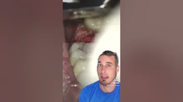 Cuando se extrae un diente