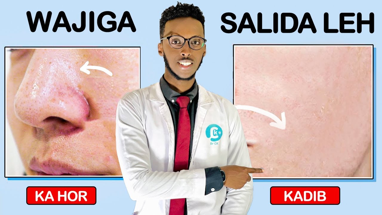 WAJIGA SALIIDA LEH IYO SIDA LOO DARYEELO | OILY FACE