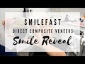 Direct Composite Veneers SMILE REVEAL! | SmileFast Trial Smile